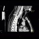 Stenosis of trachea, tracheal intubation: CT - Computed tomography